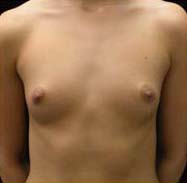 Breast Augmentation Case 3331 Before Photo Breast Augmentation