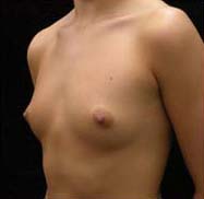 Breast Augmentation Case 3331 Before Photo Breast Augmentation