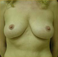 Breast Augmentation Case 3337 Before Photo Breast Augmentation