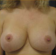 Breast Augmentation Case 3337 After Photo Breast Augmentation