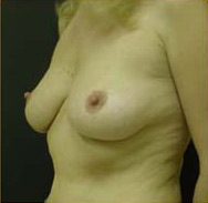 Breast Augmentation Case 3337 Before Photo Breast Augmentation