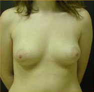Breast Augmentation Case 3343 Before Photo Breast Augmentation
