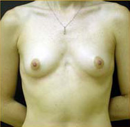 Breast Augmentation Case 3349 Before Photo Breast Augmentation