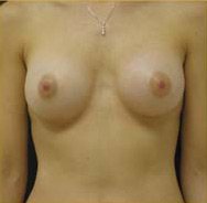 Breast Augmentation Case 3349 After Photo Breast Augmentation