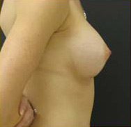 Breast Augmentation Case 3349 After Photo Breast Augmentation
