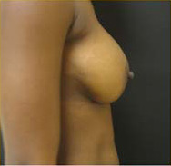 Breast Augmentation Case 3355 After Photo Breast Augmentation