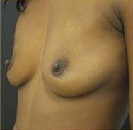 Breast Augmentation Case 3355 Before Photo Breast Augmentation