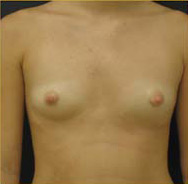 Breast Augmentation Case 3361 Before Photo Breast Augmentation