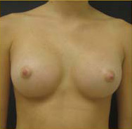 Breast Augmentation Case 3361 After Photo Breast Augmentation