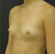 Breast Augmentation Case 3361 Before Photo Breast Augmentation