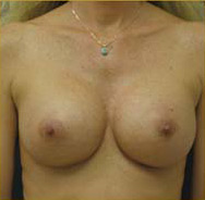 Breast Augmentation