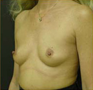 Breast Augmentation