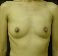 Breast Augmentation