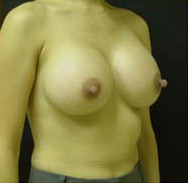 Breast Augmentation