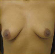 Breast Augmentation Case 3385 Before Photo Breast Augmentation