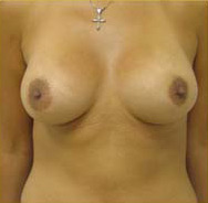 Breast Augmentation Case 3385 After Photo Breast Augmentation