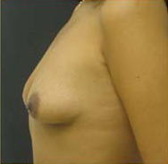 Breast Augmentation Case 3385 Before Photo Breast Augmentation