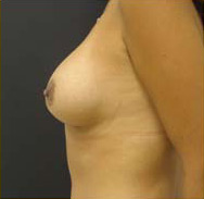 Breast Augmentation Case 3385 After Photo Breast Augmentation
