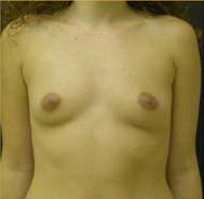 Breast Augmentation Case 3391 Before Photo Breast Augmentation