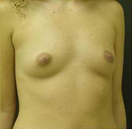 Breast Augmentation Case 3391 Before Photo Breast Augmentation