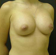 Breast Augmentation Case 3391 After Photo Breast Augmentation