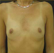 Breast Augmentation Case 3397 Before Photo Breast Augmentation