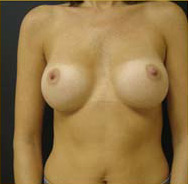 Breast Augmentation Case 3397 After Photo Breast Augmentation