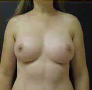 Breast Augmentation Case 3403 After Photo Breast Augmentation