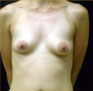 Breast Augmentation Case 3409 Before Photo Breast Augmentation