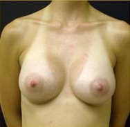 Breast Augmentation Case 3409 After Photo Breast Augmentation