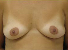 Breast Augmentation Case 3415 Before Photo Breast Augmentation