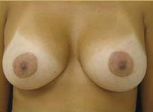 Breast Augmentation Case 3415 After Photo Breast Augmentation