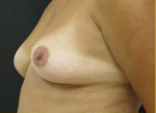 Breast Augmentation Case 3415 Before Photo Breast Augmentation