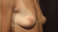 Breast Augmentation