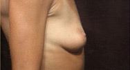 Breast Augmentation