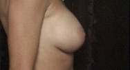 Breast Augmentation