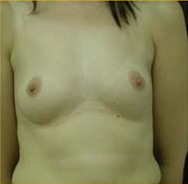 Breast Augmentation Case 3427 Before Photo Breast Augmentation