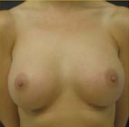 Breast Augmentation Case 3427 After Photo Breast Augmentation