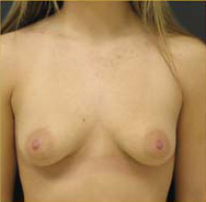 Breast Augmentation Case 3433 Before Photo Breast Augmentation