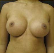 Breast Augmentation Case 3439 After Photo Breast Augmentation