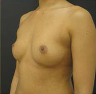 Breast Augmentation Case 3439 Before Photo Breast Augmentation