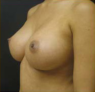 Breast Augmentation Case 3439 After Photo Breast Augmentation