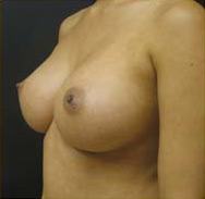 Breast Augmentation