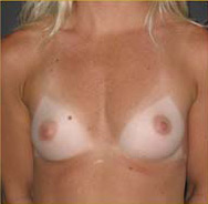 Breast Augmentation Case 3445 Before Photo Breast Augmentation