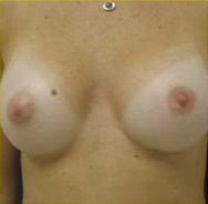 Breast Augmentation