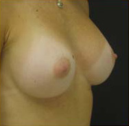 Breast Augmentation Case 3445 After Photo Breast Augmentation
