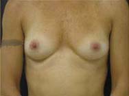 Breast Augmentation Case 3457 Before Photo Breast Augmentation