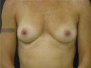 Breast Augmentation