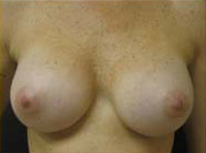 Breast Augmentation Case 3457 After Photo Breast Augmentation