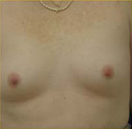 Breast Augmentation Case 3463 Before Photo Breast Augmentation